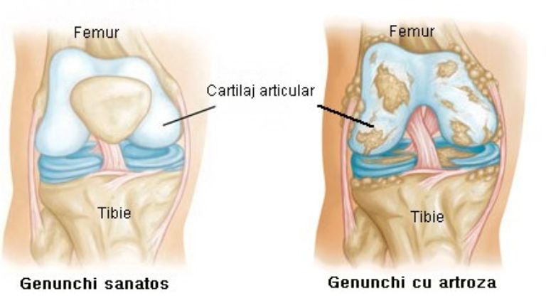 Boala Artrozica – prevenție și factori de risc