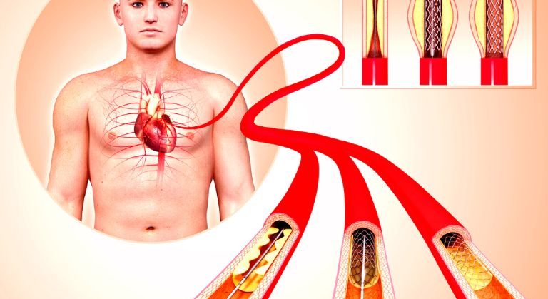 Cardiologie – Ateroscleroza – Cauze – Simptome – Tratament