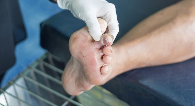 Piciorul Diabetic: Complicațiile Diabetului