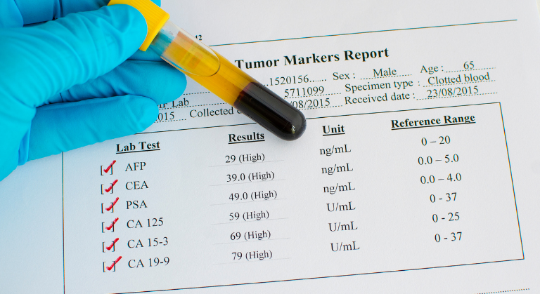 Markerii Tumorali – interpretare în diagnosticarea cancerului